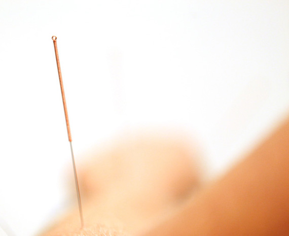 Acupuncture traditionnelle Angers