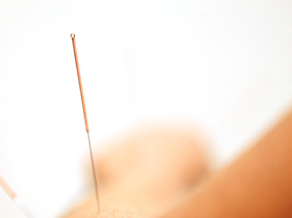 Karen Bellanger Acupuncteur